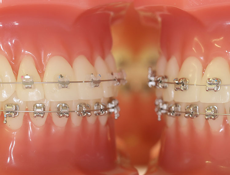 Feste Zahnspangen auf Modellen von Gebissen