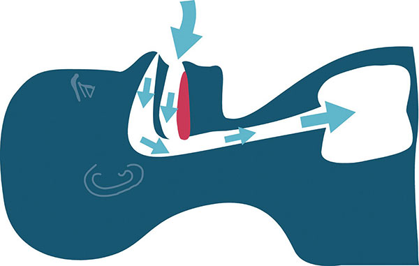 Die Schnarcherschiene verhindert, dass die Zunge nach hinten faellt